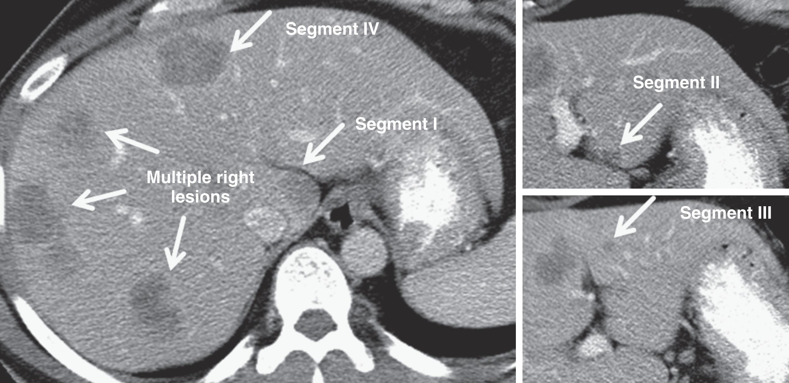 Figure 2.1, This patient with a synchronous presentation of obstructing colon cancer and multiple bilateral colorectal liver metastases presented with a total of 16 tumors involving every anatomic segment of the liver, including the caudate (segment I). Resection was possible because the lateral liver was relatively spared; after chemotherapy with response, he underwent first-stage wedge resections of the segment II and III lesions, followed by right portal vein embolization extended to segment IV, followed by second-stage extended right hepatectomy with caudate lobectomy. He never experienced recurrence in the liver.