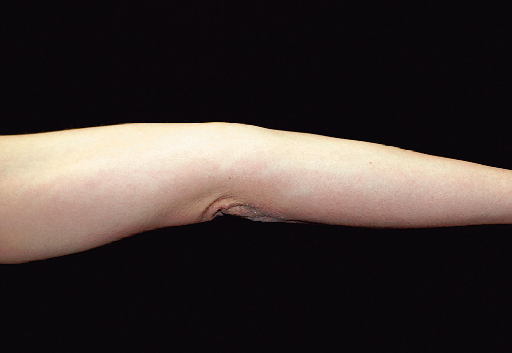 FIG. 1.2, Hyperextensibility of the elbow in a healthy, 28-year-old woman with hyperelastic skin features.