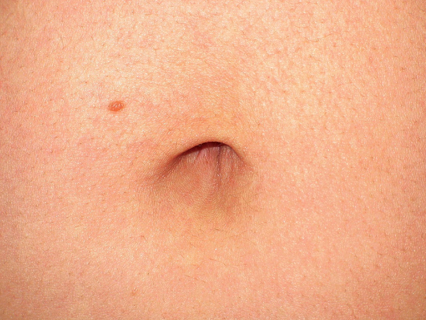 FIG. 1.4, Anterior hooding of the navel in a healthy, 30-year-old woman with hyperelastic skin features.