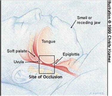 Figure 109.1, The upper airways. The most common site of the occlusion is the oropharynx or nasopharynx.