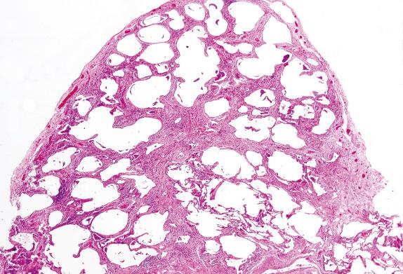 FIG. 3.11, Fibrosis (Pattern 2). The lung architecture is distorted by varying degrees of collagen deposition, giving the biopsy an overall eosinophilic (pink) appearance.