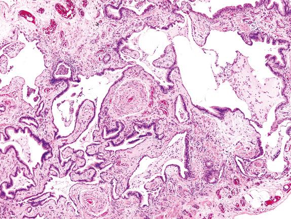 FIG. 3.13, Microscopic honeycombing (Pattern 2). Microscopic honeycombing is characterized by cystically dilated terminal airspaces lined by ciliated respiratory epithelium arising in a background of advanced fibrosis with architectural distortion. This is compared with peribronchiolar metaplasia ( Fig. 3.15 ), which also shows ciliated respiratory epithelium, but it is present in the centrilobular areas and is not associated with abundant fibrosis or cystic change.