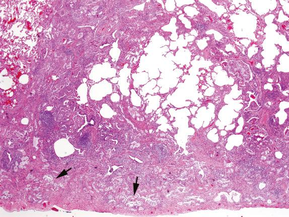 FIG. 3.16, Hermansky-Pudlak syndrome (Pattern 2). This genetic disorder results in broad irregular zones of fibrosis as seen here. Some of the fibrosis is pleural based, and some is airway centered. Note the “clear cells” of HPS even at low magnification (arrows).