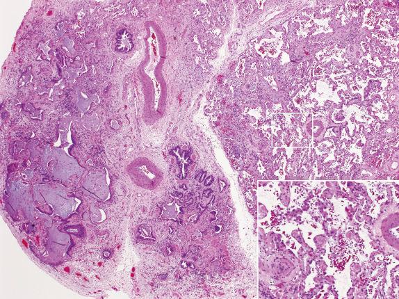 FIG. 3.17, Acute on chronic disease (Pattern 2). Acute presentation of chronic lung disease is not uncommon. When the background fibrosis is peripherally accentuated and associated with honeycombing (UIP pattern), then the acute process may be an exacerbation of the underlying disease, superimposed infection, or an unrelated acute drug toxicity. Here, note microscopic honeycombing on the left and acute lung injury on the right (inset).