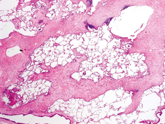 FIG. 3.18, Erdheim-Chester disease (Pattern 2). A prominent pattern of subpleural and septal fibrosis with a distinctive lymphatic distribution is seen in Erdheim-Chester disease. Characteristic osteosclerosis is usually present on radiographs, typically involving the long tubular bones.