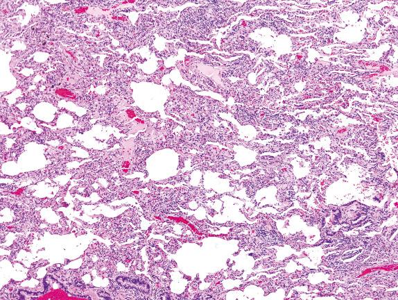 FIG. 3.19, Chronic cellular infiltrates (Pattern 3). The lung demonstrates chronic inflammation, and the biopsy has an overall blue appearance at scanning magnification. As a pattern of injury this is best classified as a cellular NSIP pattern. This example is a case of bird fanciers’ lung (a form of hypersensitivity pneumonitis).