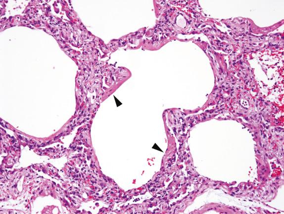 FIG. 3.3, Diffuse alveolar damage—exudative phase (Pattern 1). Proteinaceous alveolar exudates (hyaline membranes— arrowheads ) can be seen lining alveolar spaces in this example of exudative-phase DAD.