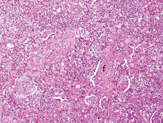 FIG. 3.5, Acute fibrinous and organizing pneumonia (AFOP) (Pattern 1). AFOP shares many features with diffuse alveolar damage. However, instead of hyaline membranes, AFOP is characterized by aggregated fibrin (f) in alveolar spaces and variable degrees of organization.