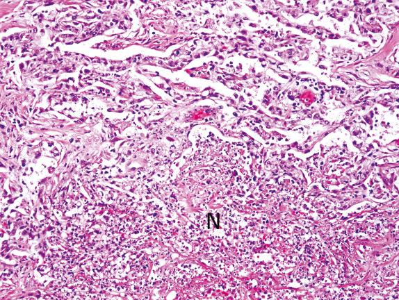 FIG. 3.6, Necrosis in DAD is a sign of infection (Pattern 1) Necrosis (N) in the setting of acute lung injury is usually an indication of infection. Necrosis can also be seen in granulomatosis with polyangiitis, lung infarction, acute aspiration, and malignant tumors. Necrosis can involve lung parenchyma alone or primarily involve airway epithelium.