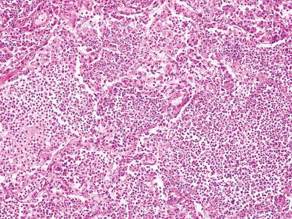 FIG. 3.7, Acute injury with alveolar neutrophils (Pattern 1). The presence of many neutrophils in the alveolar spaces is characteristic of acute bronchopneumonia and should always raise the consideration of infection.