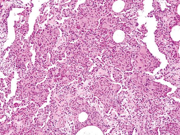 FIG. 3.8, Acute eosinophilic pneumonia (Pattern 1). Acute injury accompanied by airspace filling with variable numbers of eosinophils, plump eosinophilic macrophages, and reactive type II cell hyperplasia are characteristic of acute eosinophilic pneumonia. There is often variation in lobular intensity.