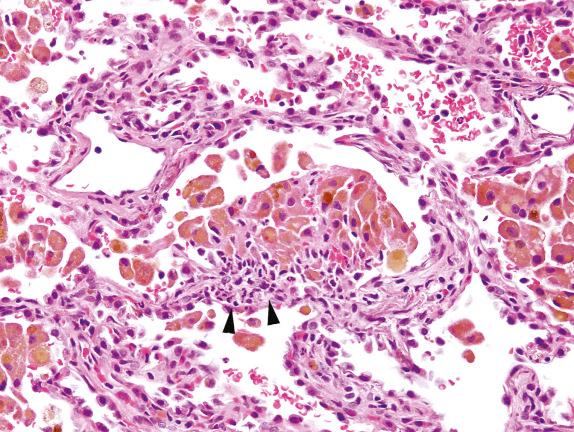 FIG. 3.9, Diffuse alveolar hemorrhage with capillaritis (Pattern 1). Alveolar hemorrhage of immune origin is characterized by both fresh hemorrhage and hemosiderin-laden macrophages in the alveolar spaces. In this case of granulomatosis with polyangiitis (GPA), capillaritis is present focally (arrowheads).