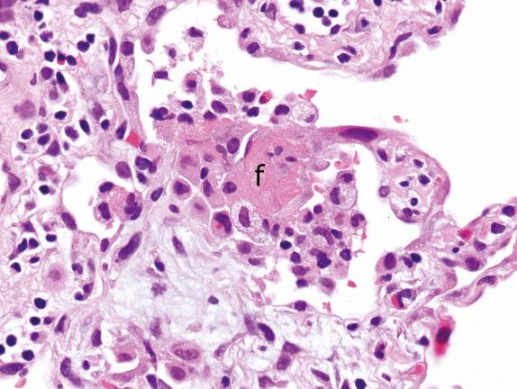 FIG. 3.10, Acute injury with vacuolated alveolar macrophages (Pattern 1). The presence of intraalveolar macrophages having a prominently vacuolated cytoplasm and associated alveolar fibrin (f) accumulation (attesting to acute injury) raises a differential diagnosis to include drug toxicity. This is a case of bleomycin toxicity.