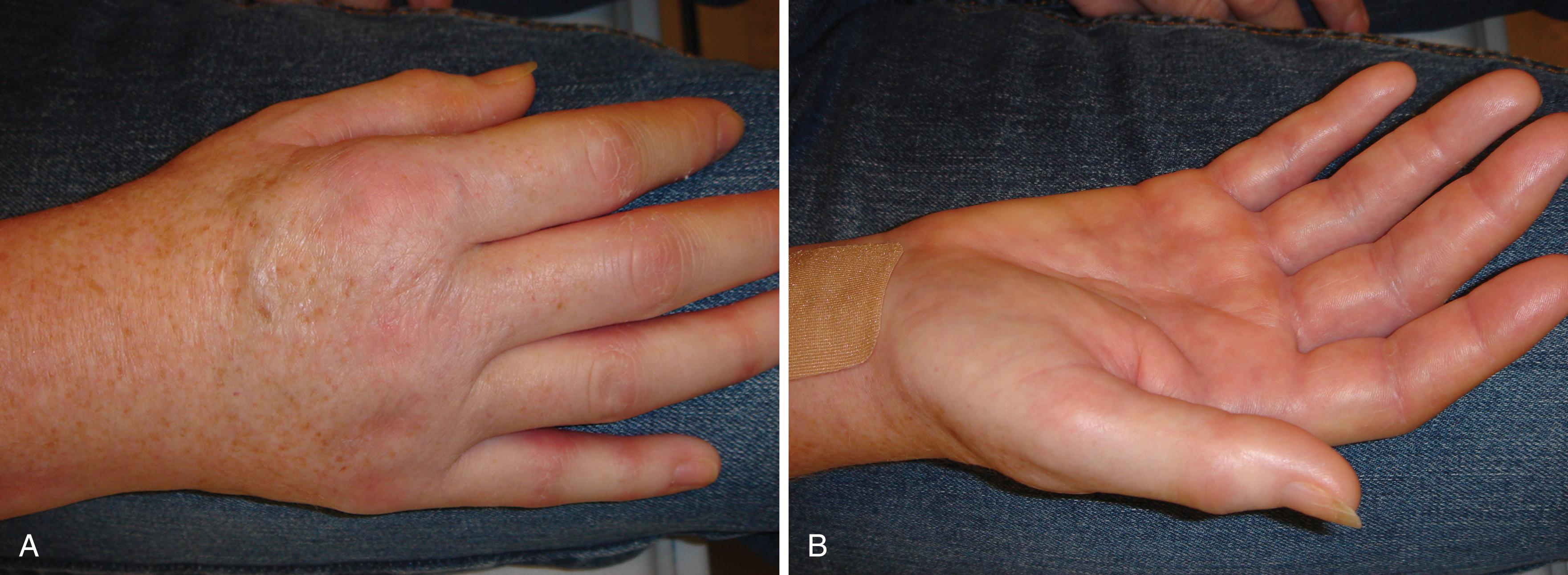 Fig. 53.1, A, Hand of a patient with complex regional pain syndrome (CRPS) showing swelling and autonomic dysfunction. B, Hand and forearm of a patient with CRPS showing trophic changes and arthrofibrosis.