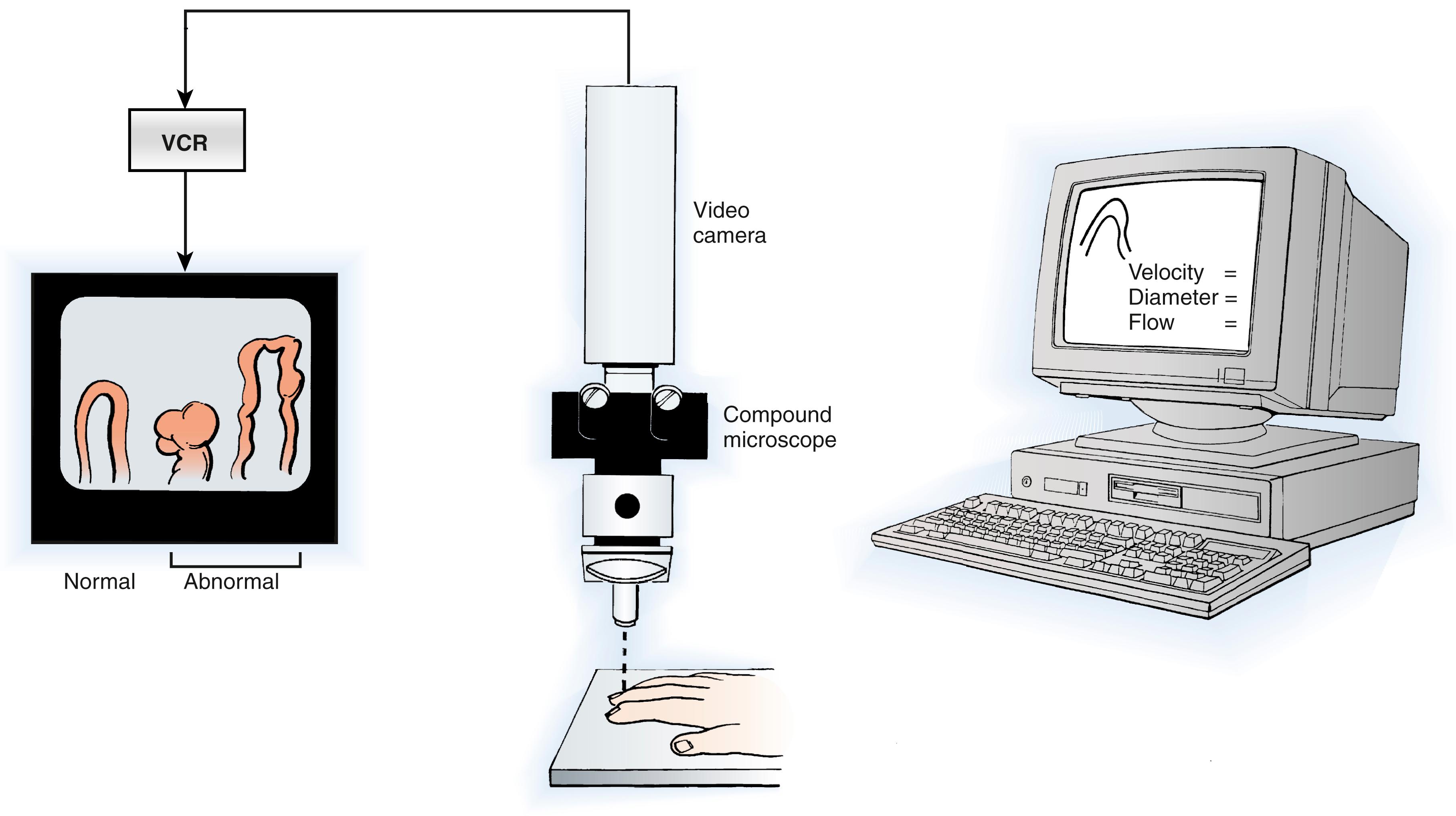 Fig. 53.11, Nutritional capillaries may be visualized directly through a compound microscope, which provides visualization of red blood cell motion within the capillaries and permits the identification of normal and abnormal capillary morphology. Videotape analysis facilitates quantitation of the diameter of the capillaries and velocity of flow within the ascending and descending capillary loop. Abnormal morphology diagnostic of collagen vascular disease can be observed. VCR, Videocassette recorder.