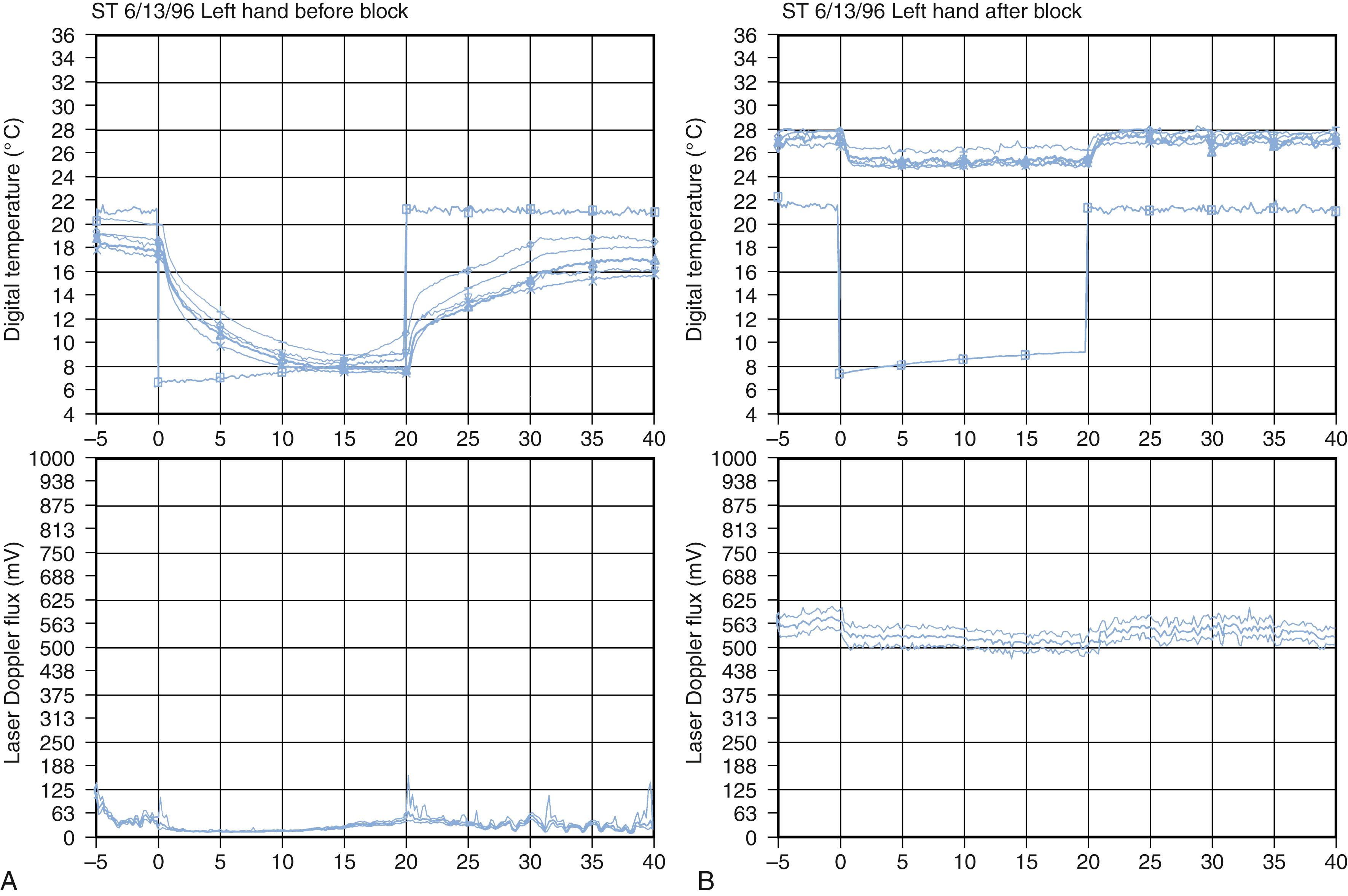 Fig. 53.12, Laser Doppler fluxmetry in a patient with clinical RSD before (A) and after (B) sympathetic blockade. The temperature of all five fingers of the left hand and the environmental temperature (indicated by squares ) are plotted in the upper portion of the graphs. Laser Doppler measurements were monitored with a probe placed on the left ring finger. Baseline temperatures and laser Doppler measurements were taken for 5 minutes. For the cooling phase, the hands were inserted into the refrigeration unit for 20 minutes. After cooling, the hands were removed from the unit and allowed to rewarm at room temperature for 20 minutes. After sympathetic blockade, digital temperatures were increased markedly during all phases of the testing procedure. The amplitude of laser Doppler flux was increased after the block, thus confirming modulation of sympathetic input (chemical sympathectomy).