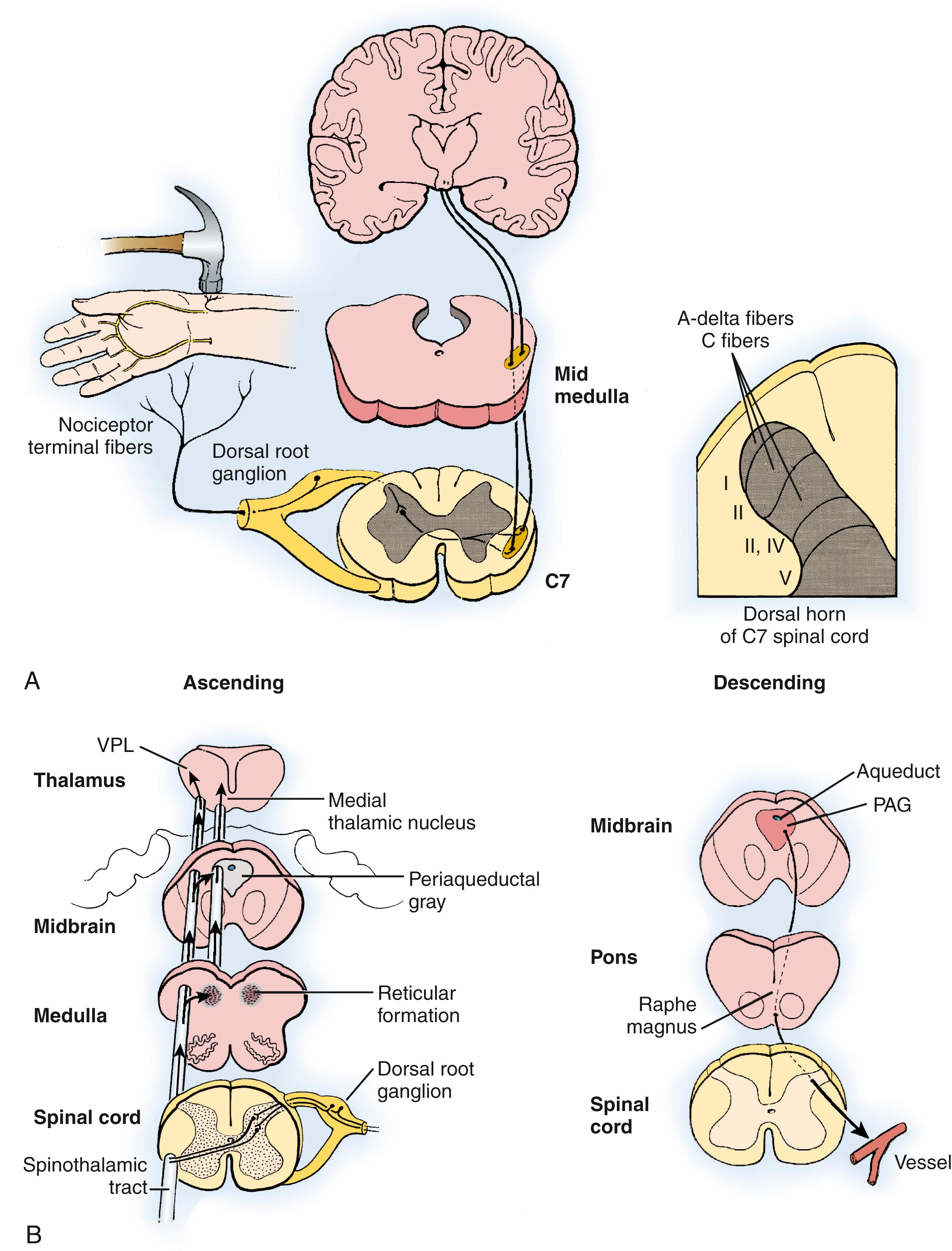 Fig. 53.2, A, Abnormal central nervous system modulation of afferent sensory stimuli may contribute to the development of a dystrophic response after an injury that produces a peripheral nociceptive focus or “trigger.” B, Ascending and descending pathways in the spinal cord and brain. PAG, Periaqueductal gray matter; VPL, ventral posterolateral nucleus.