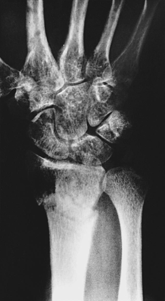 Fig. 53.5, Plain radiograph of a patient with type 1 complex regional pain syndrome after fracture of the distal ends of the radius and ulna. The fracture line is visible. There is diffuse osteopenia in addition to juxtacortical demineralization and subchondral erosions and cysts.