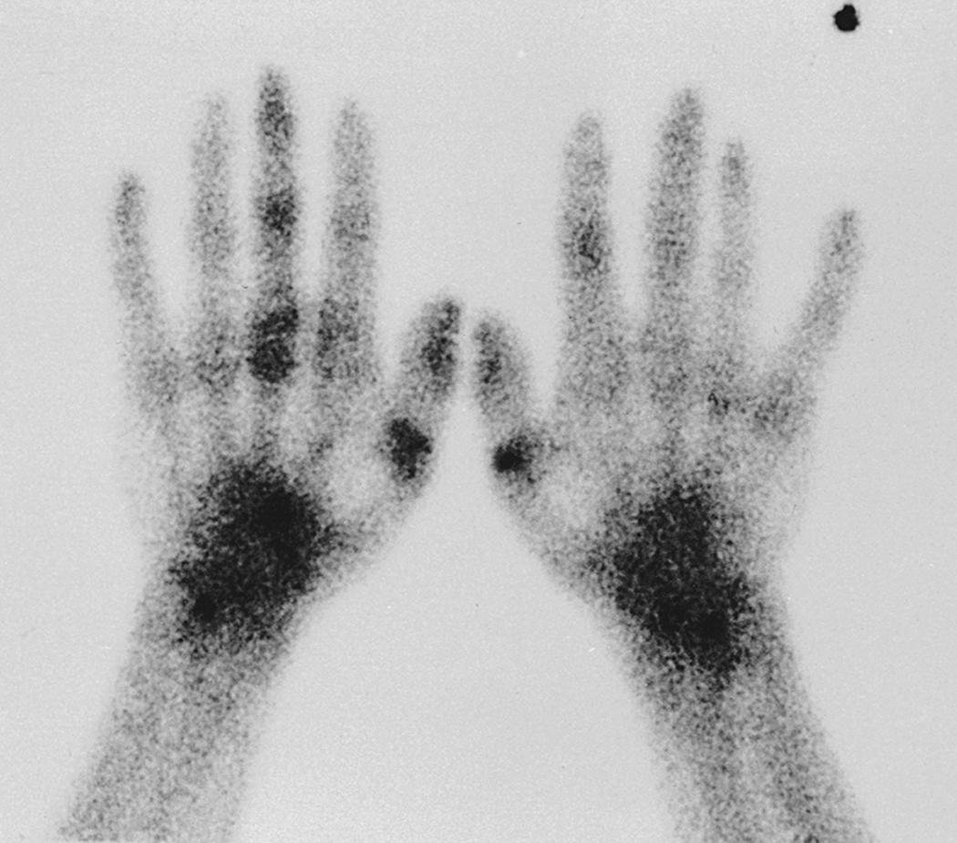 Fig. 53.8, Segmental periarticular uptake confined to a digit in a bone scan of a patient with complex regional pain syndrome isolated to the long finger.