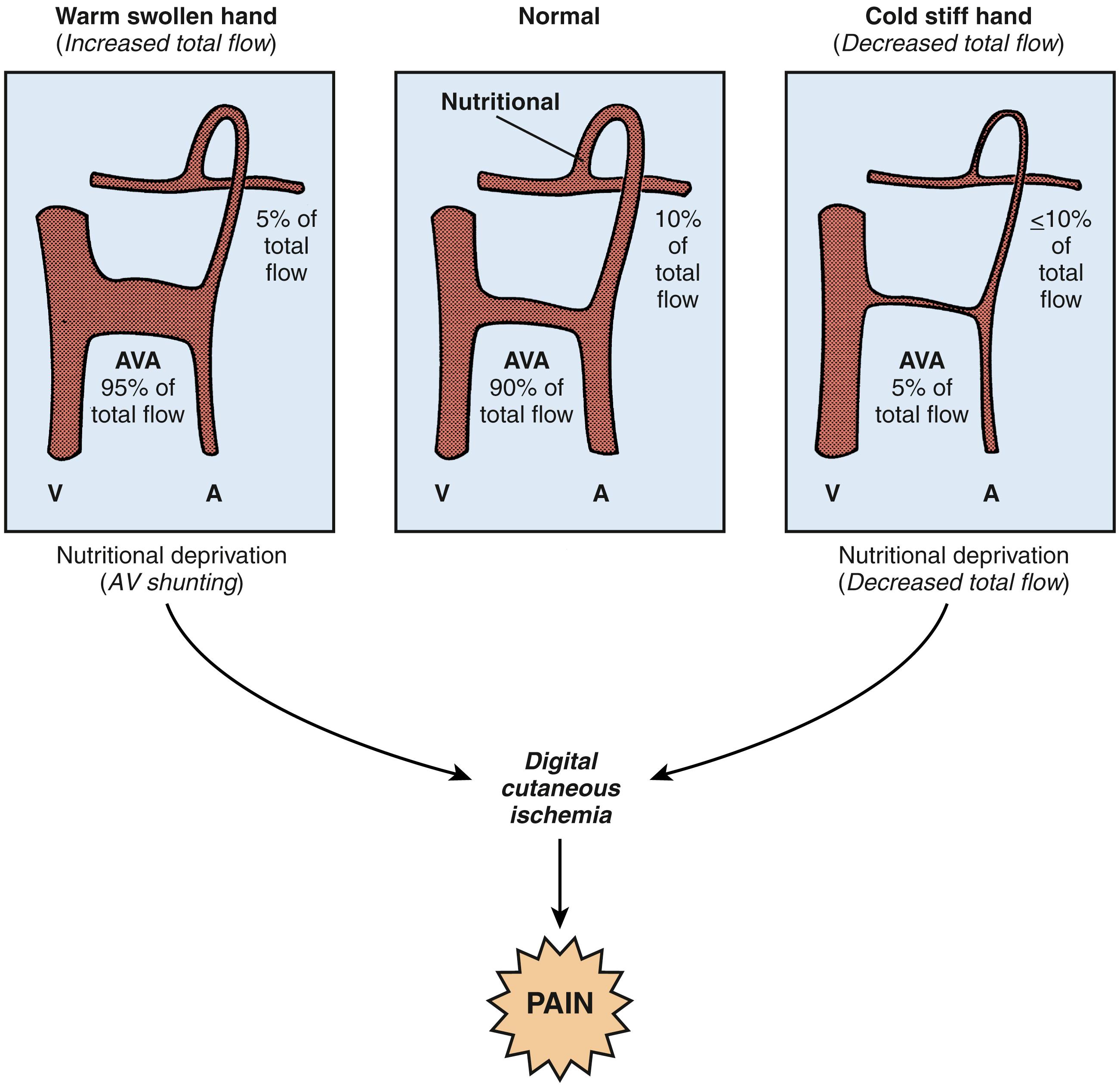 Fig. 53.9, In a warm, swollen hand with increased total digital blood flow and in a cold, stiff hand with decreased digital flow, abnormal arteriovenous (AV) control through an arteriovenous anastomosis (AVA) may produce or contribute to abnormally decreased nutritional blood flow and pain.