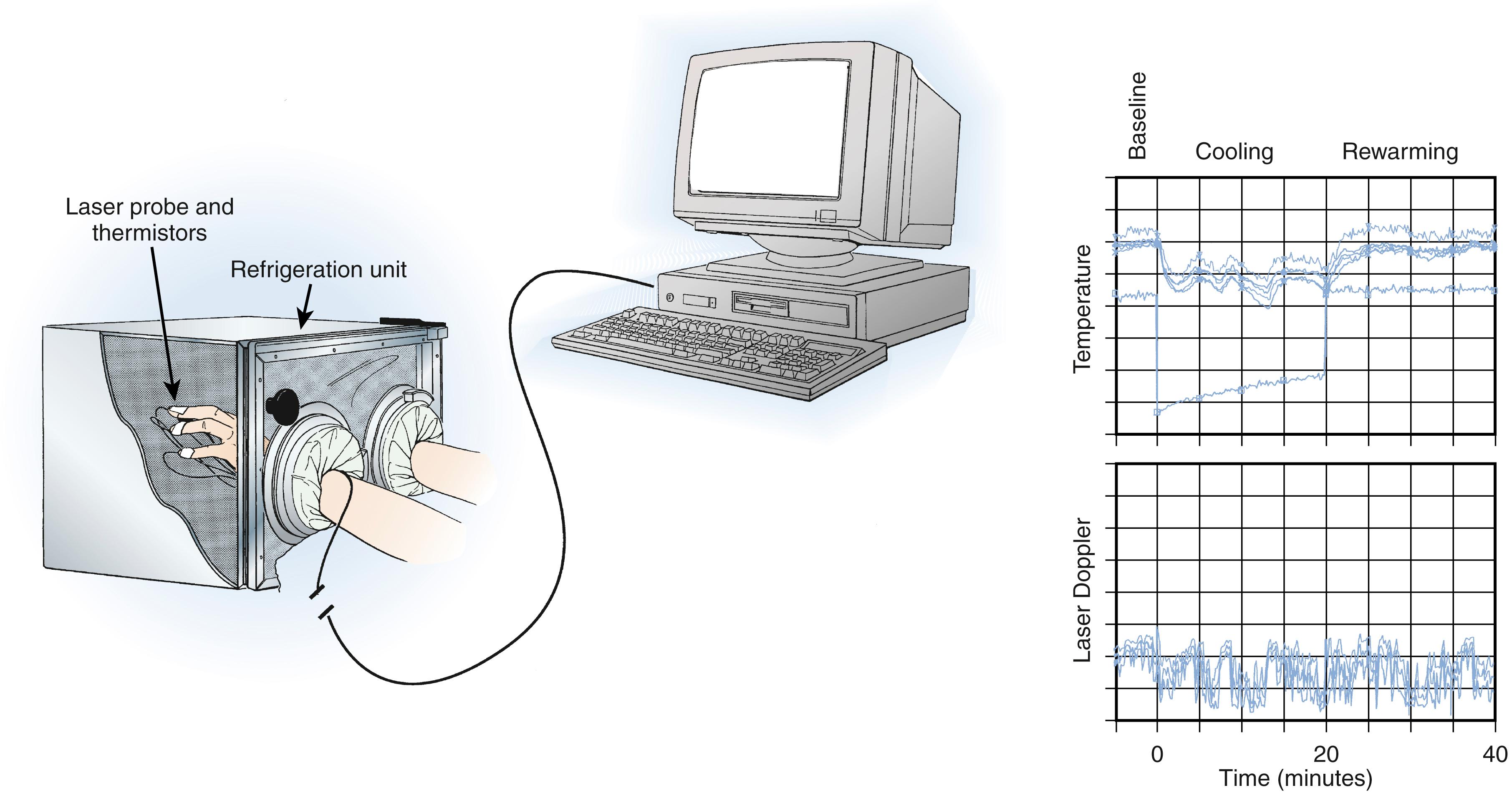 Fig. 53.10, Digital microvascular physiology can be evaluated by using an isolated cold stress test combining digital temperature and laser Doppler fluxmetry measurements. Digital temperatures are monitored with thermistors attached to each digit of both extremities. Microvascular cutaneous perfusion is assessed with a laser Doppler probe attached to one digit of each extremity. Digital temperature and laser Doppler fluxmetry measurements are sampled with the use of custom computer software, and the results of the test are plotted for analysis.