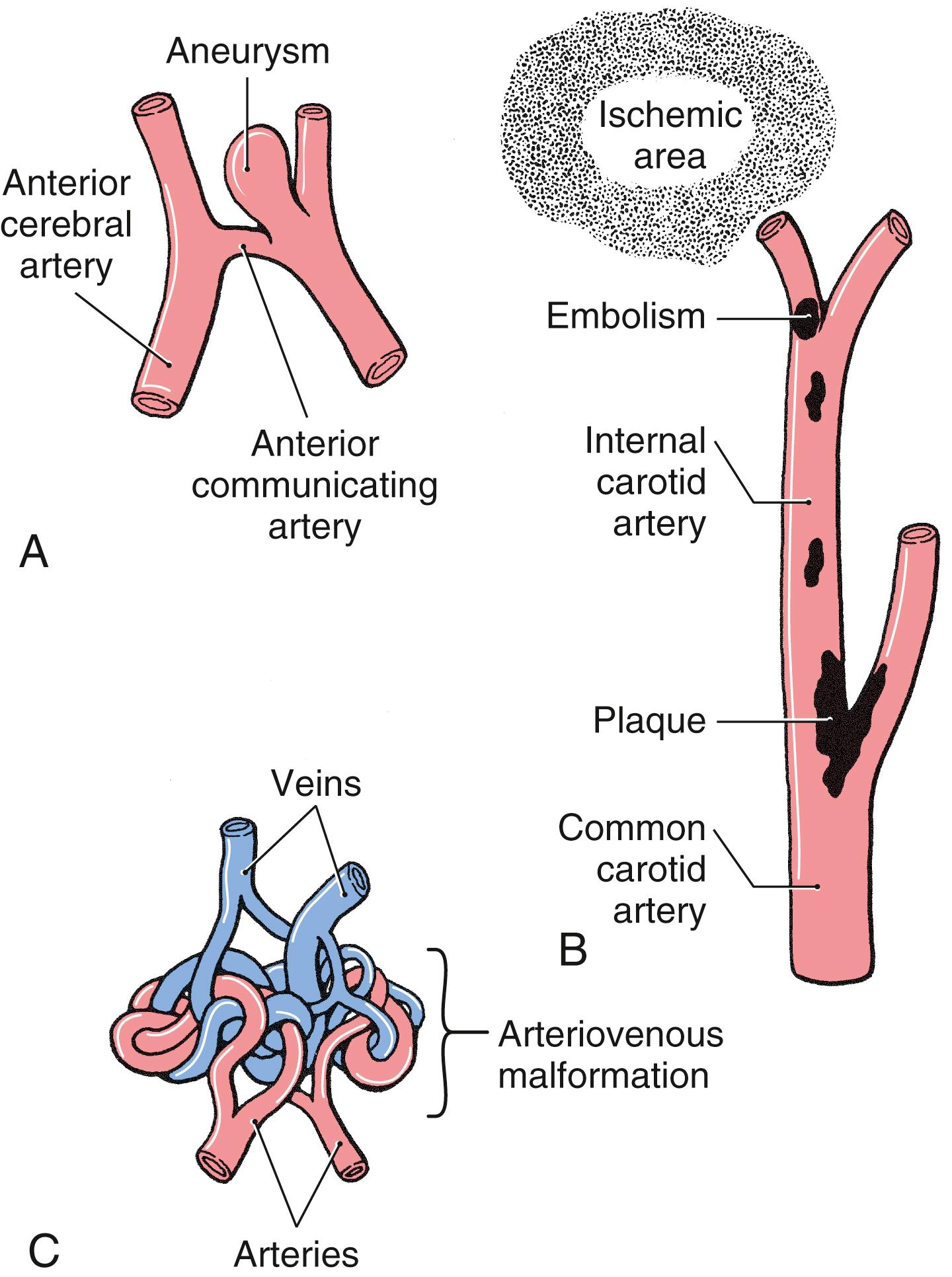 Fig. 8.1, Representation of an aneurysm ( A ), an embolism ( B ), and an arteriovenous malformation ( C ).