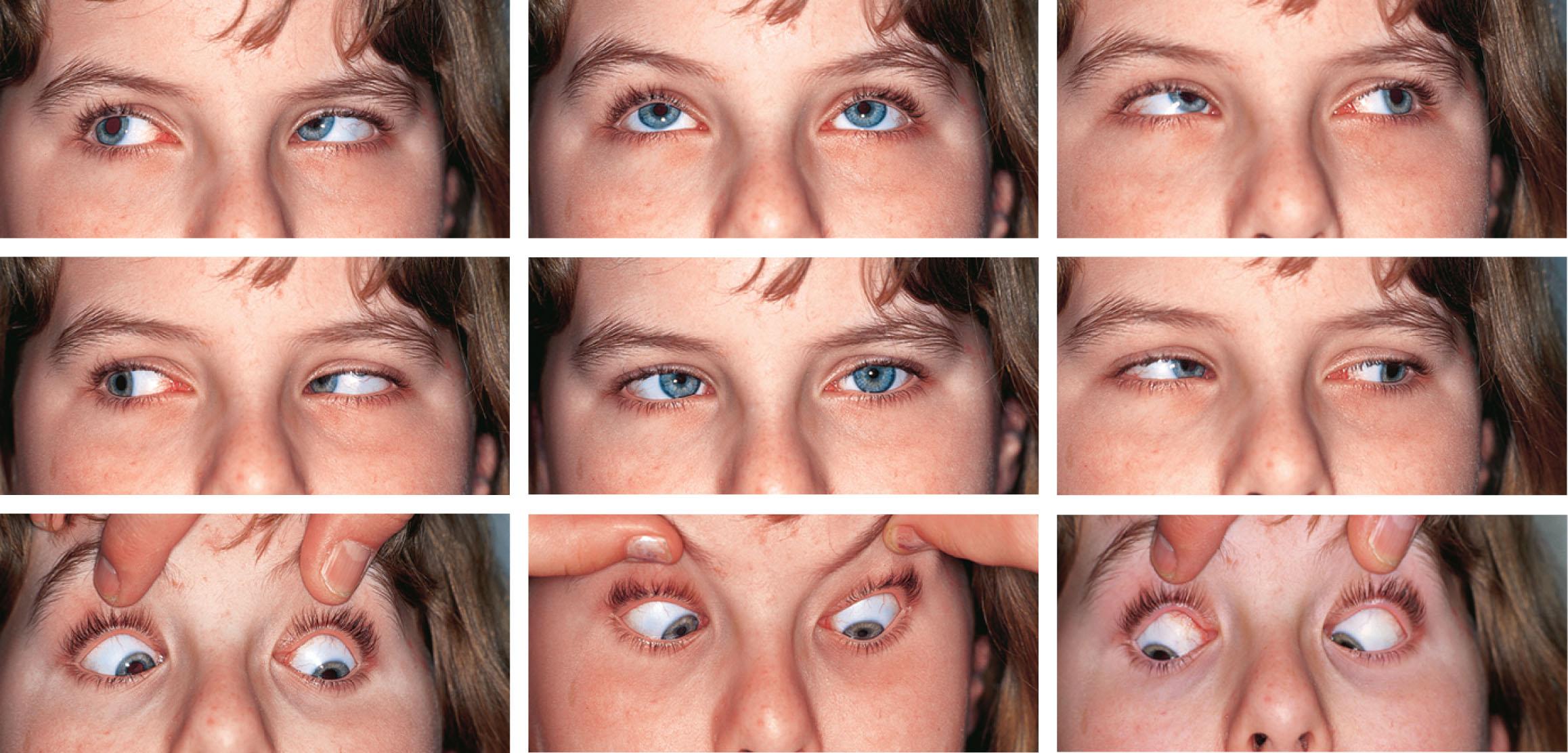 Fig. 83.1, “V” pattern esotropia. This girl has a V pattern esotropia with associated inferior oblique muscle overaction and superior oblique muscle underaction.