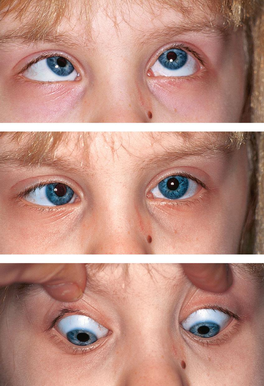 Fig. 83.2, “A” pattern esotropia. This girl has an A pattern esotropia showing an increase in the deviation in upgaze and orthophoria in downgaze.