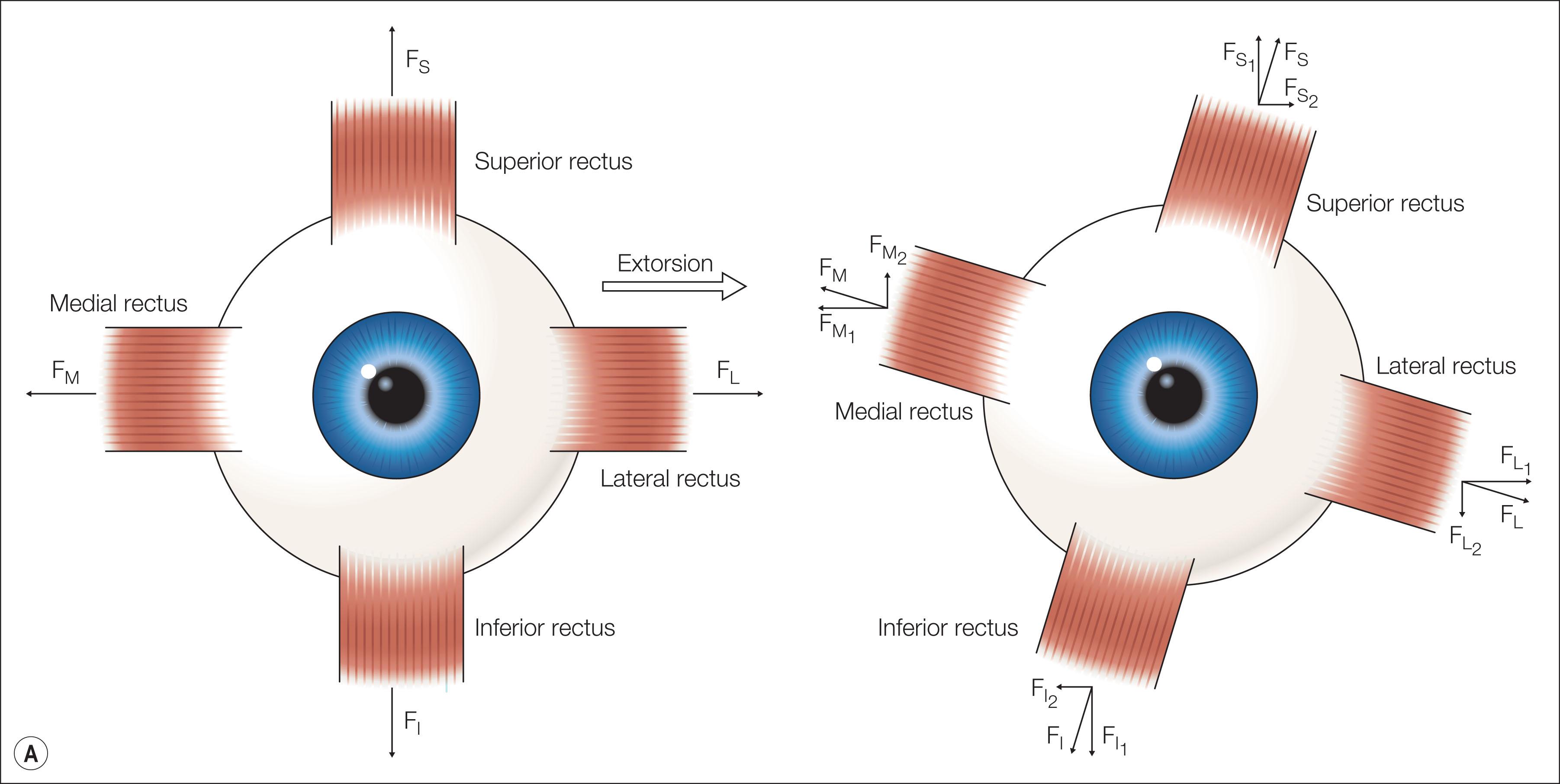 Fig. 83.4, (A) Effect of torsion on individual muscle function. An excyclorotation of the left eye will result in a clockwise rotation of the insertion of the muscles. This will create a vector for elevation for the medial rectus muscle, abduction for the superior rectus, depression for the lateral rectus, and adduction for the inferior rectus. (B) Effect of torsion on motility pattern. If the torsional changes that are depicted in (A) occurred in both eyes, the new force vectors would cause divergence in upgaze and convergence in downgaze. In addition, there would be an elevation of the adducting eye and depression of the abducting eye. Thus, these torsional changes that occurred as a result of extorsion contribute to both the V pattern and the elevation seen in adduction.