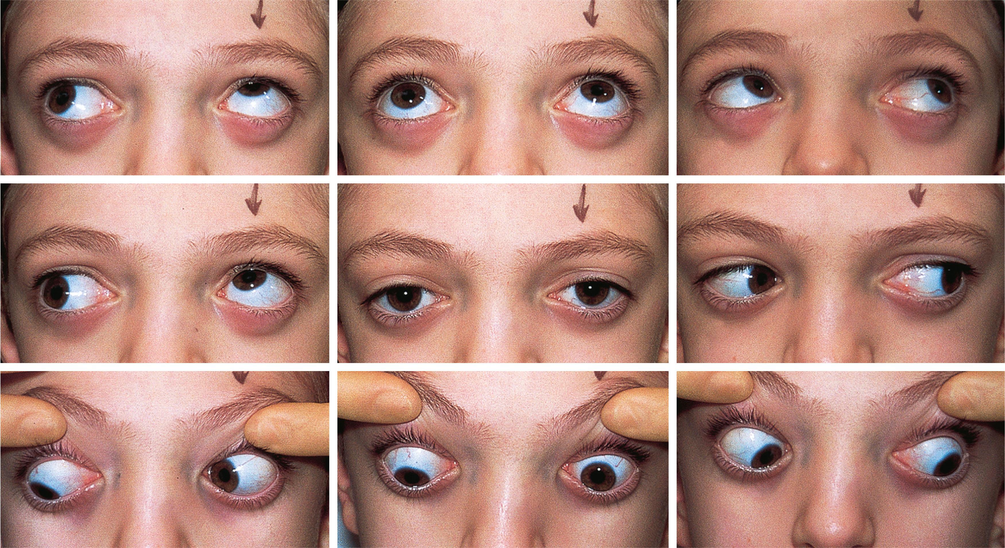 Fig. 83.5, Craniofacial anomaly with associated pattern: Crouzon syndrome. This boy shows the classic V pattern seen in Crouzon syndrome (see Chapter 26 ). There is overelevation and underdepression of each eye in adduction.