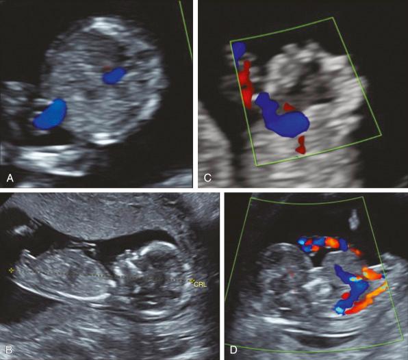 • Fig. 32.1, A composite of ultrasound images showing normal anatomy in axial and longitudinal section ( A and B ) and demonstrating the presence of gastroschisis ( C ) and exomphalos ( D ) at 12 weeks’ gestation. CRL, Crown–rump length.