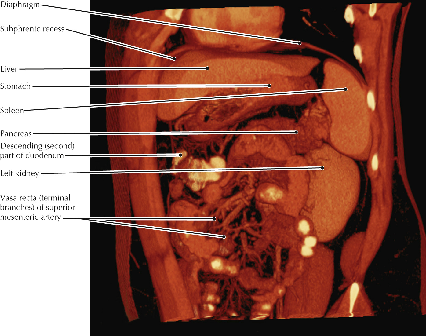 Oblique coronal slab, volume rendered display, abdominal CT