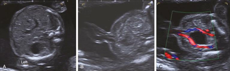 • Fig. 32.2, A composite of ultrasound images showing normal anatomy in axial sections through the upper abdomen ( A ), at the level of the umbilicus ( B ) and in the pelvis ( C ) at 20 weeks’ gestation.