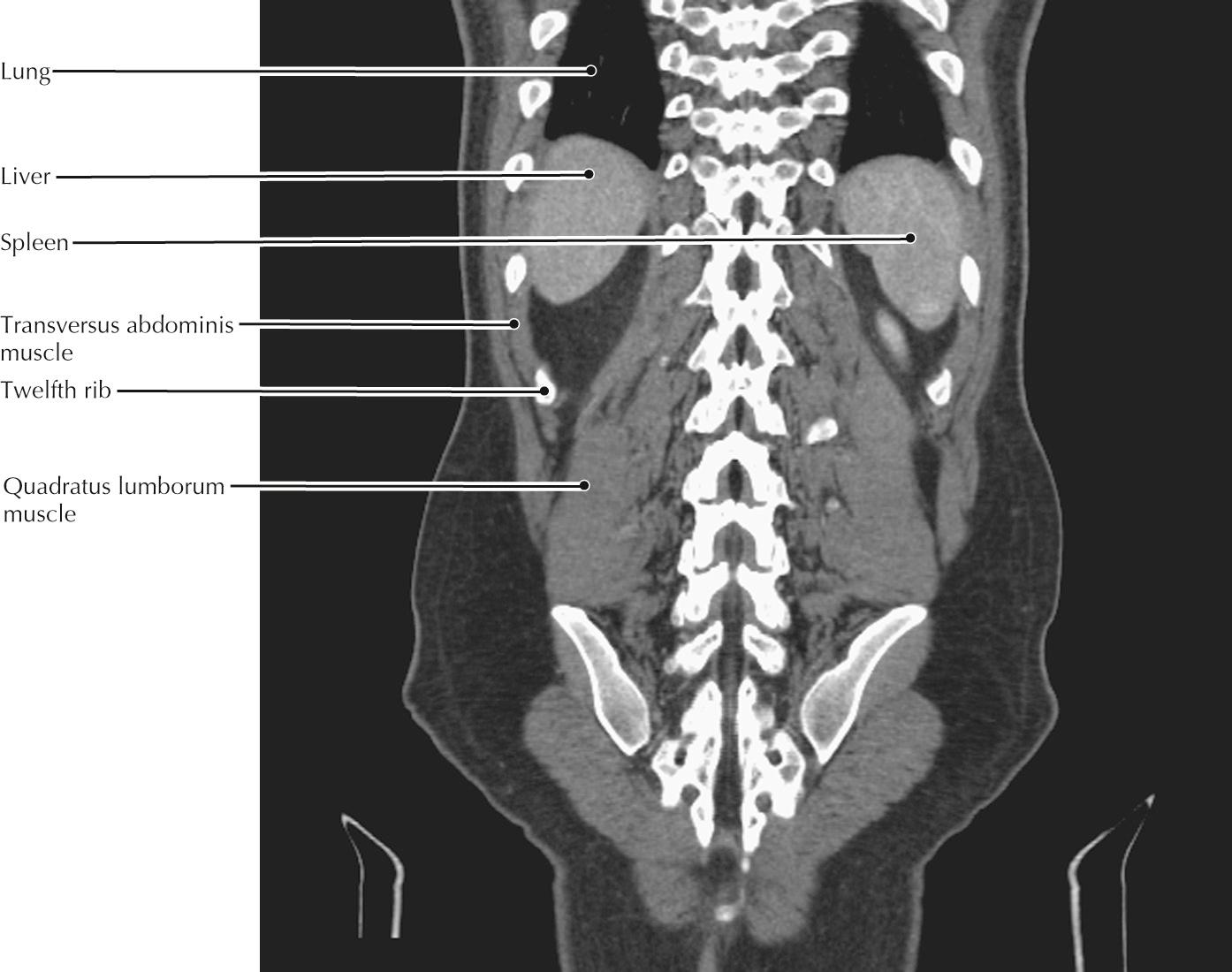 Curved coronal reconstruction, thoracolumbar CT