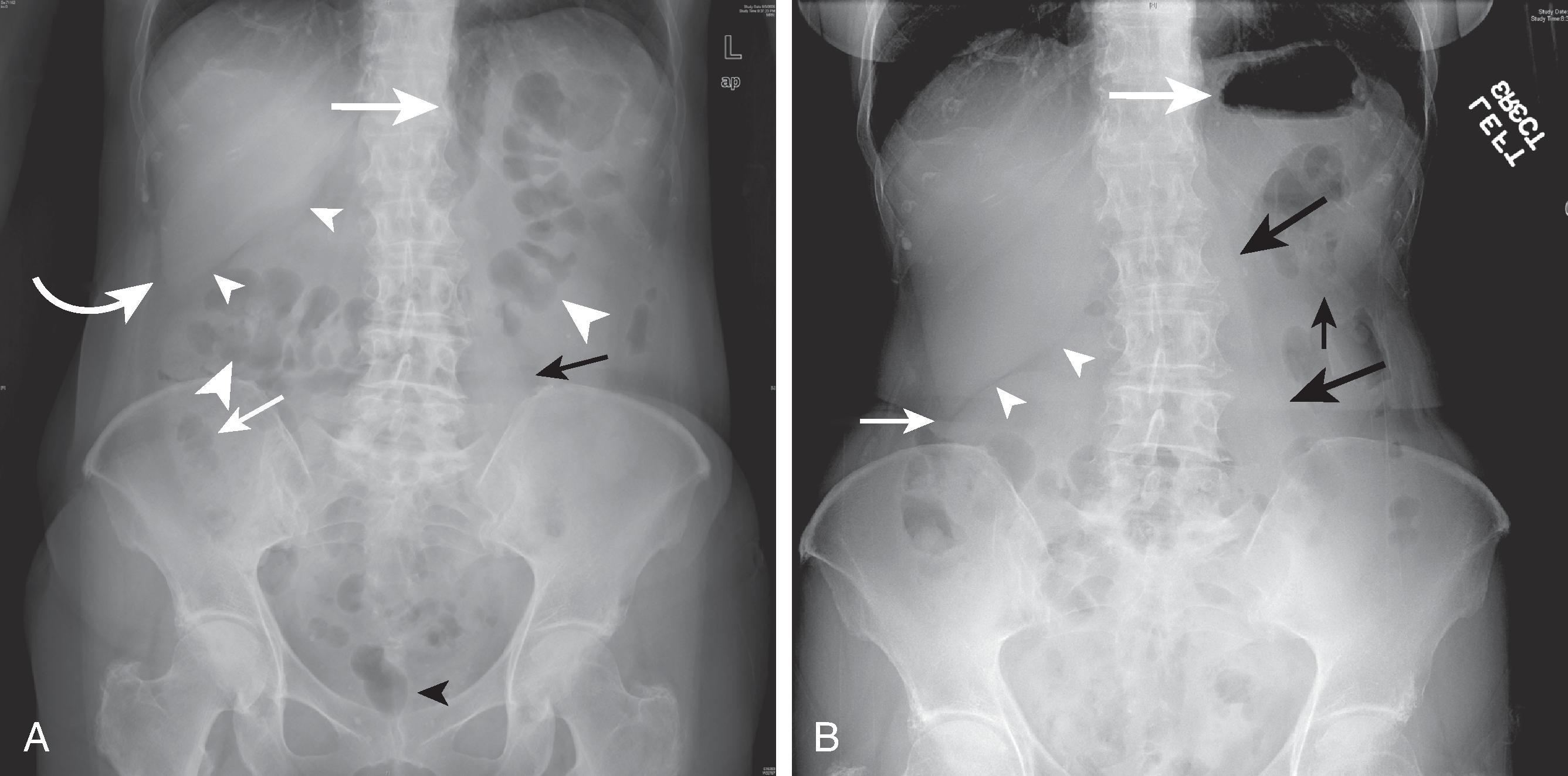 Fig. 1.1, Normal supine and upright abdominal radiographs. (A) Supine abdominal radiograph shows a normal bowel gas pattern with gas in the stomach ( large white arrow ), small bowel ( small white arrow ), transverse colon ( large white arrowheads ), and rectum ( black arrowhead ). The hepatic angle ( curved white arrow ) is outlined by extraperitoneal fat, and the posteromedial surface of the right lobe of the liver is outlined by perirenal fat ( small white arrowheads ). The left psoas muscle ( black arrow ) is also seen. (B) Upright abdominal radiograph shows a normal air-fluid level in the stomach ( large white arrow ). Note the hepatic angle ( small white arrow ), posteromedial surface of the right lobe of the liver ( arrowheads ), left psoas muscle ( large black arrows ), and splenic tip ( small black arrow ).