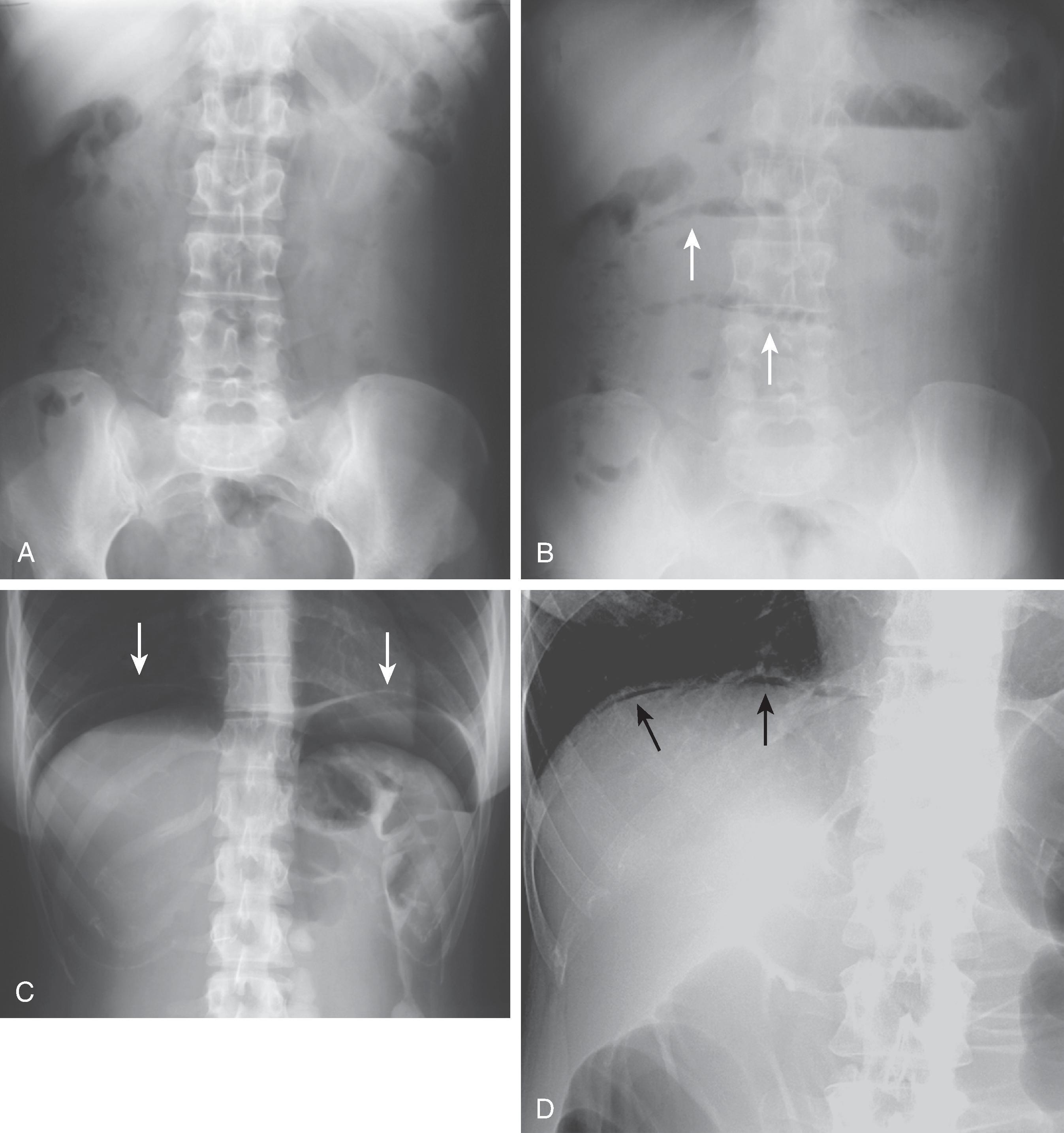 Fig. 1.2, Value of upright abdominal radiograph in patients with small bowel obstruction or intestinal perforation. (A) Supine abdominal radiograph shows a relatively gasless abdomen in a patient with signs and symptoms of intestinal obstruction. (B) Upright radiograph in the same patient shows multiple tiny air-fluid levels ( arrows ) caused by fluid-filled loops of dilated small bowel with trapping of air superiorly in these loops (producing the string-of-pearls sign). The patient was found at surgery to have a closed-loop small bowel obstruction secondary to adhesions. (C) Upright abdominal radiograph in another patient whose supine radiograph did not reveal any free air shows a large amount of free intraperitoneal air ( arrows ) beneath both hemidiaphragms. (D) Upright abdominal radiograph in a third patient shows a tiny amount of free air ( arrows ) between the liver and right hemidiaphragm.