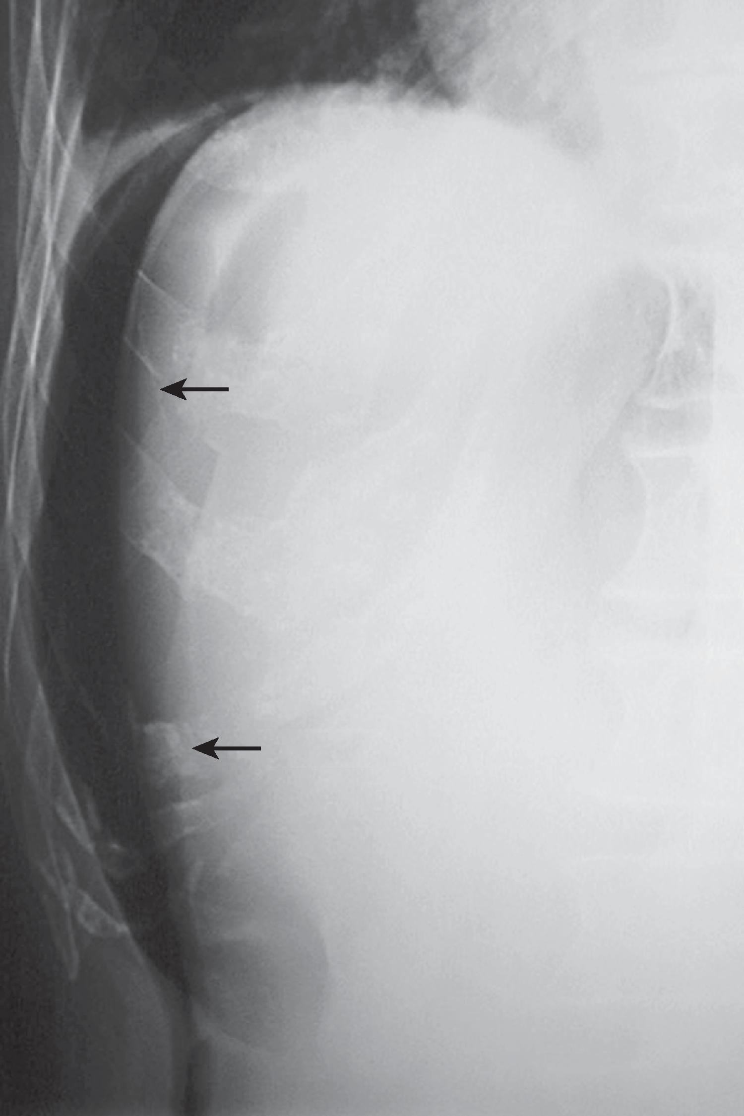 Fig. 1.3, Value of left lateral decubitus radiograph of the abdomen in a patient with pneumoperitoneum. Coned-down view of the right upper quadrant from a left lateral decubitus radiograph shows obvious free intraperitoneal air ( arrows ) between the liver and right lateral abdominal wall. A supine abdominal radiograph did not show the free air.