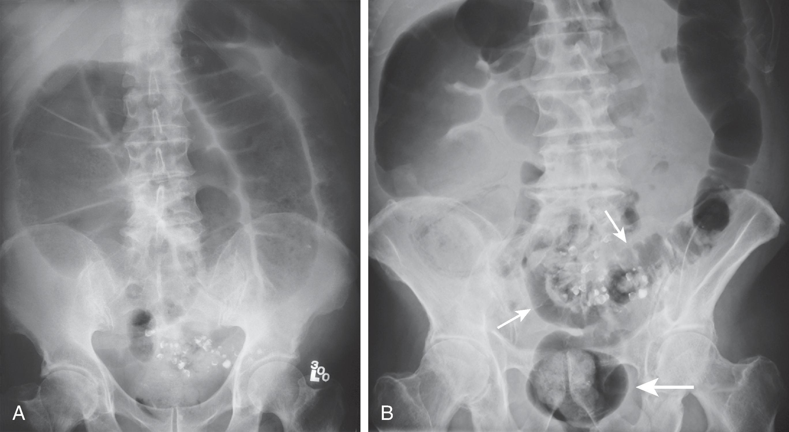 Fig. 1.4, Value of prone abdominal radiograph in patients with suspected colonic obstruction. (A) Supine abdominal radiograph shows dilated colon to the level of the distal descending colon with a paucity of gas in the sigmoid colon and rectum. These findings are worrisome for distal colonic obstruction. (Note residual barium in sigmoid diverticula). (B) Prone abdominal radiograph in the same patient shows considerable gas in the sigmoid colon ( small arrows ) and rectum ( large arrow ), indicating that the patient has a colonic ileus rather than distal colonic obstruction.