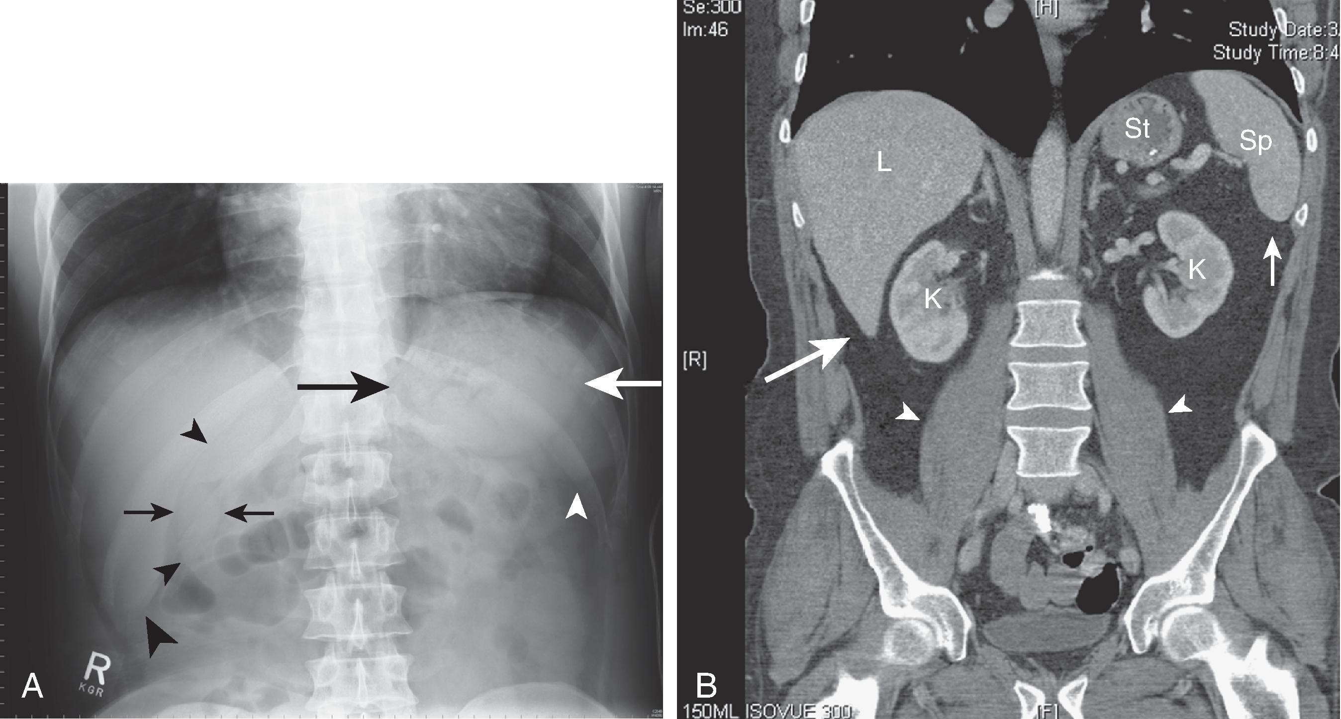 Fig. 1.5, Gallbladder, liver, spleen, and stomach. (A) Supine abdominal radiograph shows the gallbladder ( small black arrows ), hepatic angle ( large black arrowhead ), splenic tip ( white arrowhead ), and stomach ( large black and white arrows ). Note the partially visualized right kidney ( small black arrowheads ). (B) Coronal computed tomography scan of the abdomen shows the hepatic angle ( large arrow ), splenic tip ( small arrow ), psoas muscles ( arrowheads ), and kidneys. K, Kidney; L, liver; Sp, spleen; St, stomach.