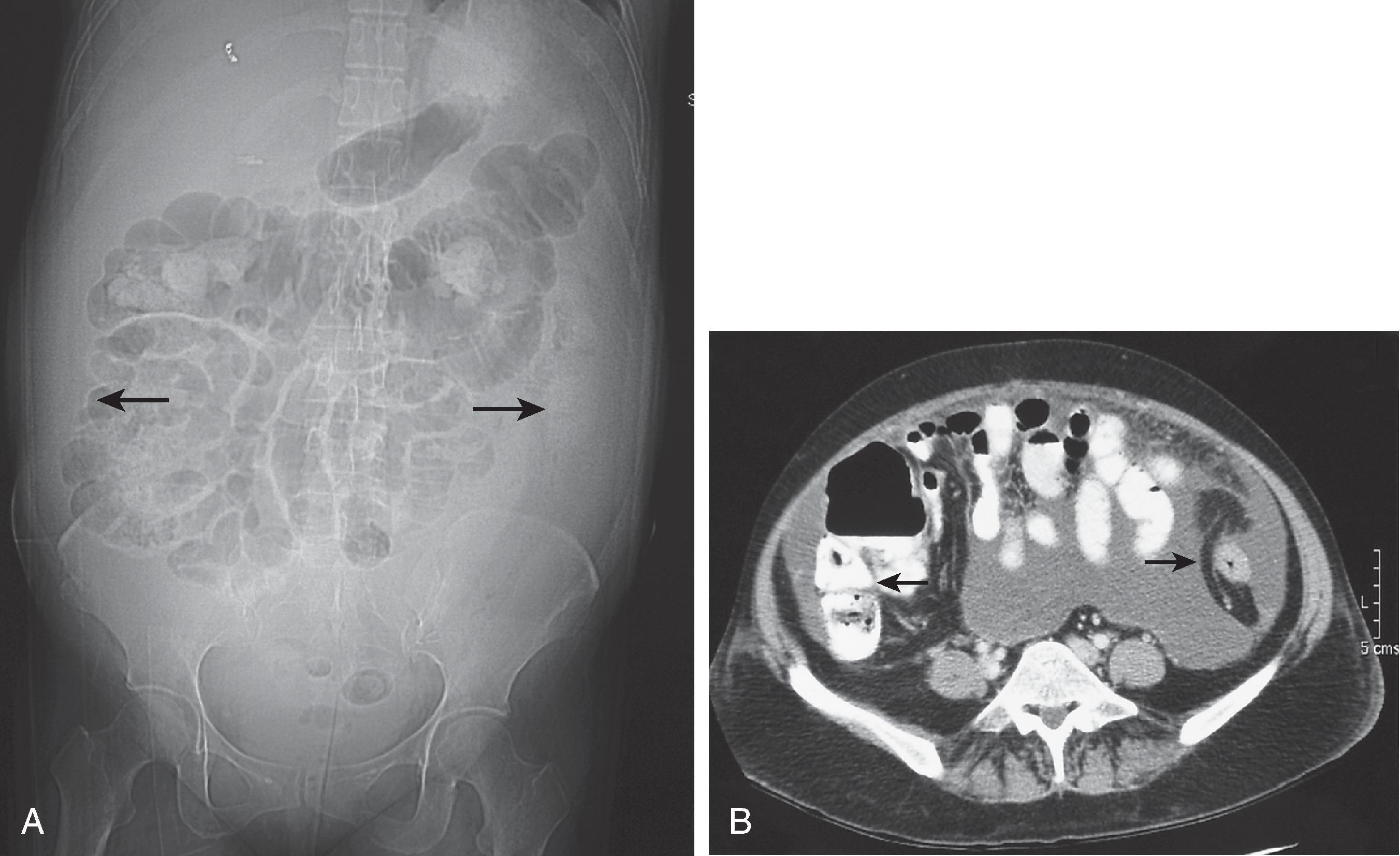 Fig. 1.6, Intraperitoneal fluid (hemorrhage) in paracolic gutters. (A) Supine abdominal radiograph in a patient with a traumatic liver laceration shows a large amount of fluid in both paracolic gutters ( arrows ) displacing bowel medially from the flank stripes. Note the central location of small bowel loops with closely spaced valvulae conniventes. Also note the loss of the hepatic angle normally outlined by extraperitoneal fat. The bleeding was controlled by embolization of the liver (note the radiopaque coil overlying the liver). (B) Axial computed tomography scan of the abdomen confirms the presence of ascitic fluid displacing adjacent bowel ( arrows ) from the paracolic gutters.