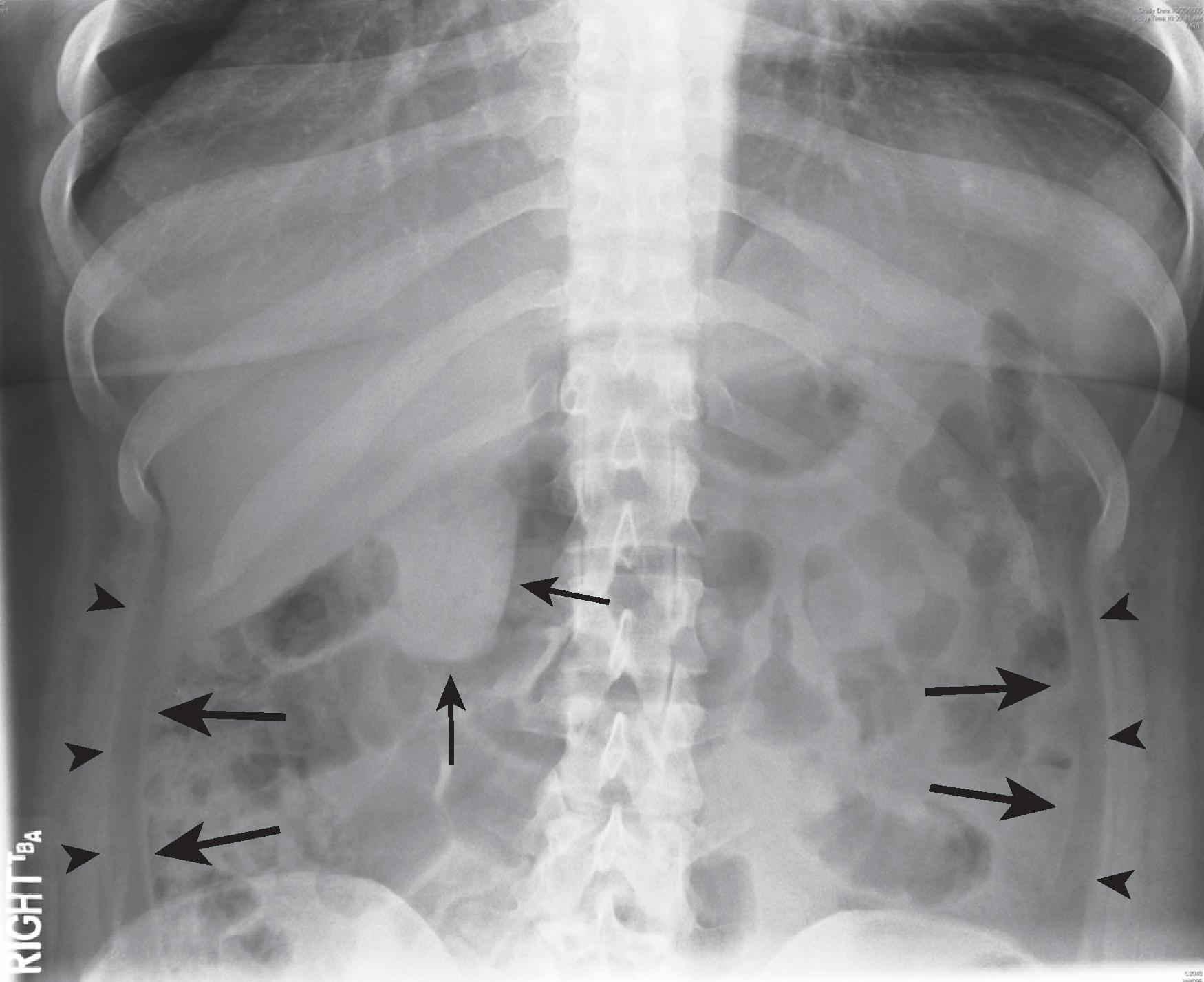 Fig. 1.7, Paracolic gutters and lateroconal fascia. Coned-down view from supine abdominal radiograph shows the left and right paracolic gutters between the transversalis fascia ( arrowheads ) and lateroconal fascia ( large arrows ). Small arrows denote the gallbladder.