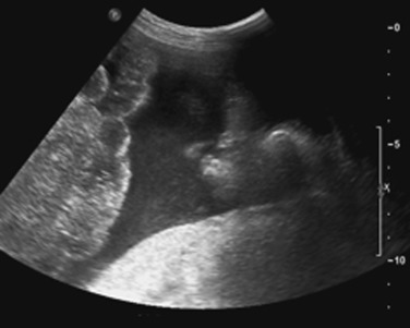 FIGURE 3-1, Intraperitoneal hemorrhage due to blunt abdominal trauma. A focused abdominal sonogram for trauma of the abdomen shows complex free fluid in the left lower quadrant in this patient after a motor vehicle collision.
