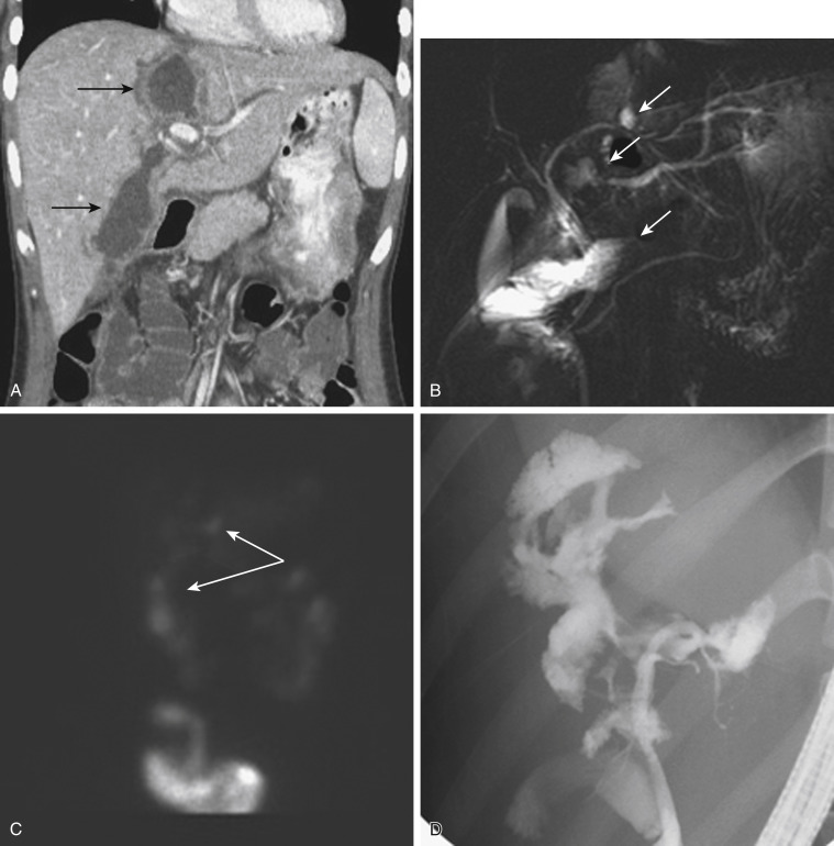 FIGURE 3-11, A biliary leak with biloma after blunt abdominal trauma. A, A coronal computed tomography image obtained several days after the initial trauma demonstrates two focal fluid collections in the intrahepatic and perihepatic regions (arrows). B, Coronal thick slab magnetic resonance cholangiopancreatography also demonstrates the presence of several extraluminal fluid collections as focal areas of increased signal on this fluid-sensitive sequence (arrows). C, A hepatobiliary scan obtained in the anterior projection confirms the presence of bilomas with radiotracer located outside the expected lumen of the biliary tree (arrows). D, Endoscopic retrograde cholangiopancreatography was performed to further characterize the injury and for possible stent placement and confirms the presence of a bile duct injury.