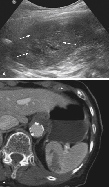 FIGURE 3-12, A splenic hematoma. A, A focused ultrasound of the left upper quadrant demonstrates a focal region of heterogeneity in the spleen (arrows), suggestive of an acute splenic injury. B, Computed tomography performed after the initial ultrasound confirms the presence of an acute splenic hematoma.