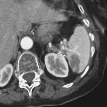 FIGURE 3-13, A splenic hematoma after a motor vehicle collision. Axial computed tomography during the portal venous phase demonstrates a wedge-shaped hypodense region in the spleen (arrow), consistent with a subcapsular hematoma and characterized as a grade II injury according to the American Association for the Surgery of Trauma trauma scale (see Table 3-2 ).