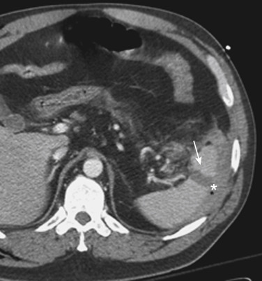 FIGURE 3-14, A splenic laceration after a motor vehicle accident. An axial computed tomography image obtained during the portal venous phase of contrast enhancement demonstrates a focal linear laceration in the spleen (arrow) that extends from the anterior to posterior surface, fracturing the spleen into two fragments. A perisplenic hematoma (asterisk) is evident posterior to the area of the injury.