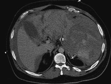 FIGURE 3-15, A shattered spleen is shown on an axial computed tomography image obtained during the portal venous phase of contrast enhancement after a motor vehicle injury. No definable splenic tissue is present in the left upper quadrant. Instead, the shattered splenic tissue is surrounded by a large amount of perisplenic hematoma that extends to the midline. Blood is also present along the surface of the right lobe of the liver. The patient required an emergent splenectomy to control the severe blood loss from this acute splenic injury.