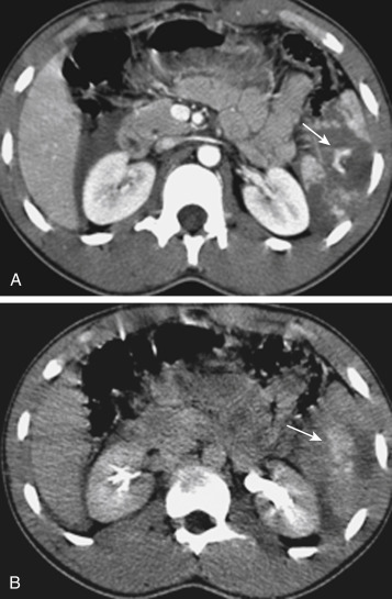 FIGURE 3-16, A splenic injury after blunt abdominal trauma. A, An axial computed tomography image obtained during the portal venous phase of contrast enhancement demonstrates a complex splenic injury containing both complex lacerations and parenchymal hematoma. Active extravasation of contrast material is present (arrow). B, A delayed image obtained 5 minutes later with a decreased radiation dose (100 mA) confirms the presence of active extravasation (as opposed to a contained vascular injury) by demonstrating continued diffusion of the contrast material into the surrounding parenchymal hematoma (arrow) .