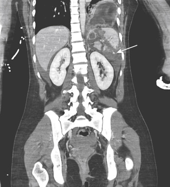 FIGURE 3-17, An 18-year-old woman who had been in a motor vehicle collision. A coronal contrast-enhanced computed tomography image demonstrates a shattered spleen with active extravasation of intravenous contrast (arrow) and a left diaphragmatic rupture with the stomach in the left hemithorax.