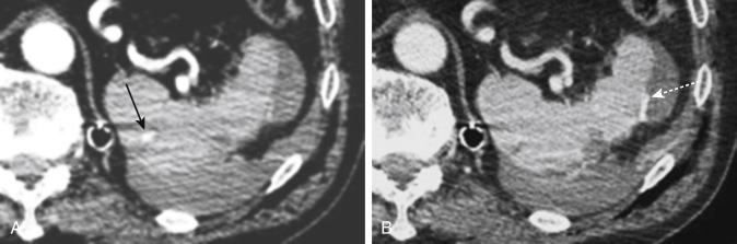 FIGURE 3-18, A 30-year-old woman with a splenic laceration who was in a motor vehicle collision. An axial computed tomography image in the arterial phase ( A ) demonstrates a splenic-contained vascular injury (arrow), and an image in the portal venous phase ( B ) also demonstrates active extravasation (dashed arrow) . Note that the contained vascular injury is only seen on the arterial phase. The patient underwent coil embolization of these splenic vascular injuries.